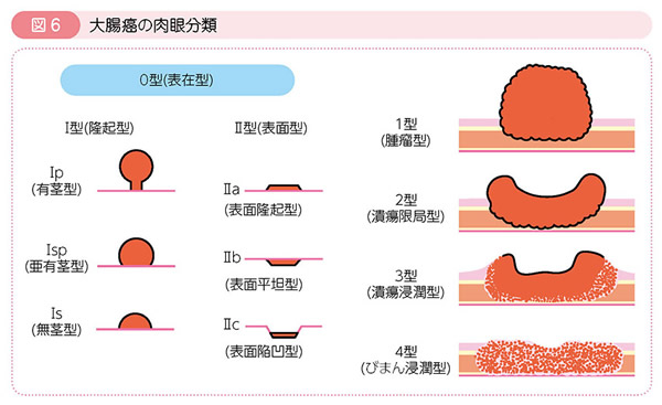 の ん 大腸 症状 末期 が