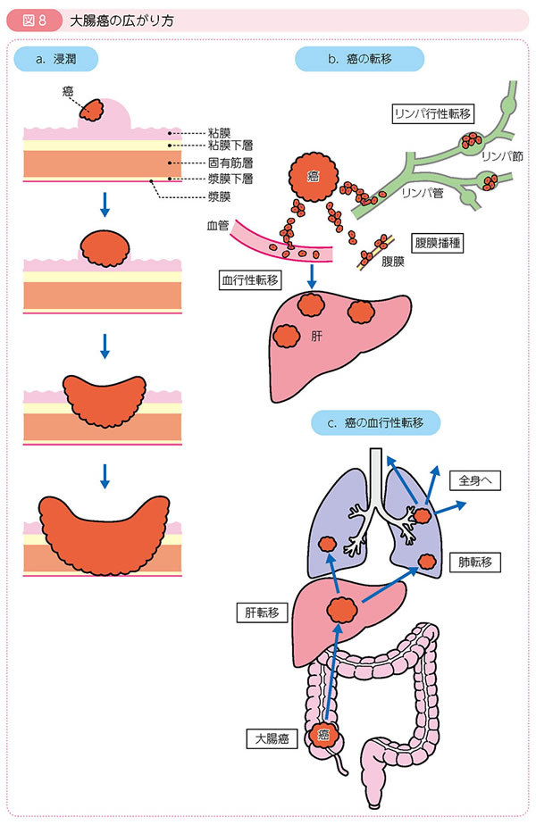 図8 大腸癌の広がり方