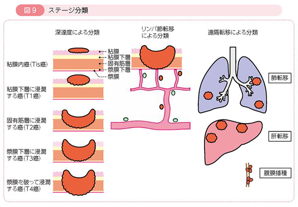 図9 ステージ分類