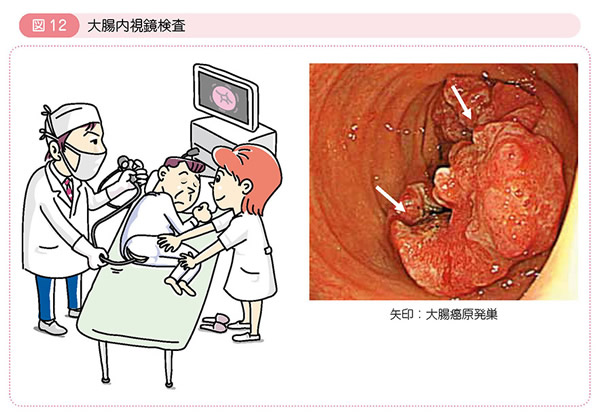 の ん 大腸 症状 末期 が