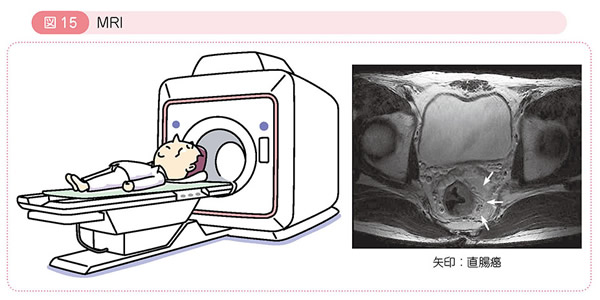 図15 MRI