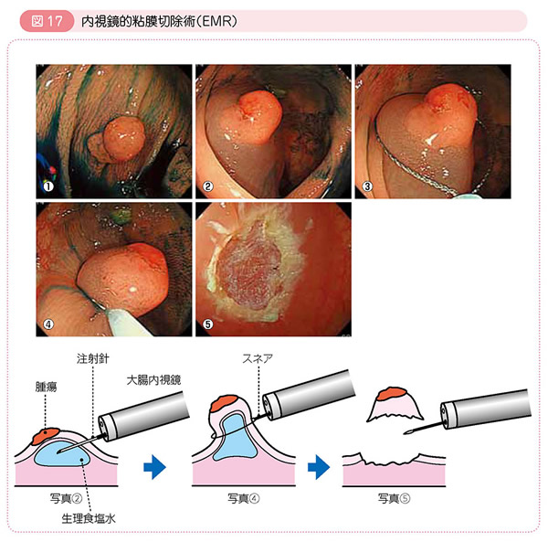 が 視 大腸 ん 鏡 手術 内