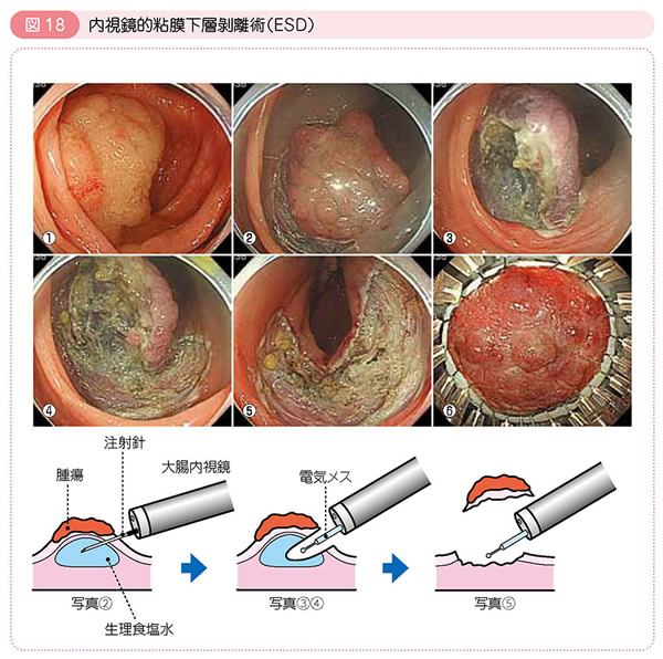 図18 内視鏡的粘膜下層剥離術（ESD）