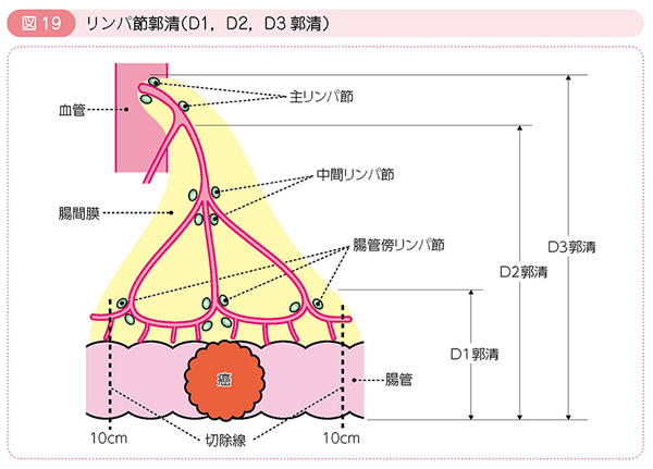 図19 リンパ節郭清（D1，D2，D3郭清）