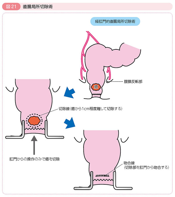 図21 直腸局所切除術