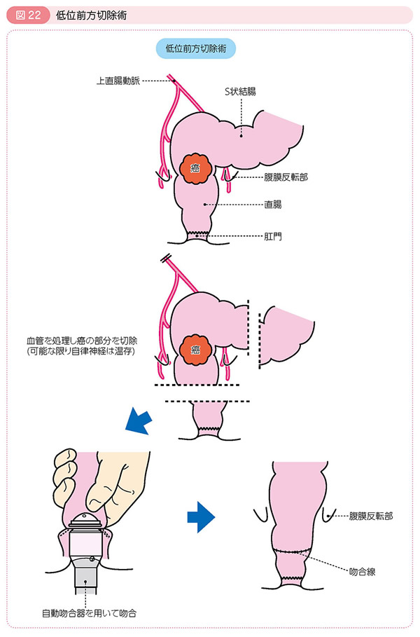 図22 低位前方切除術