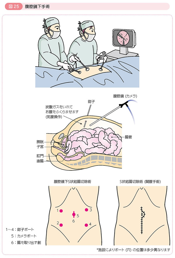 図25 腹腔鏡下手術