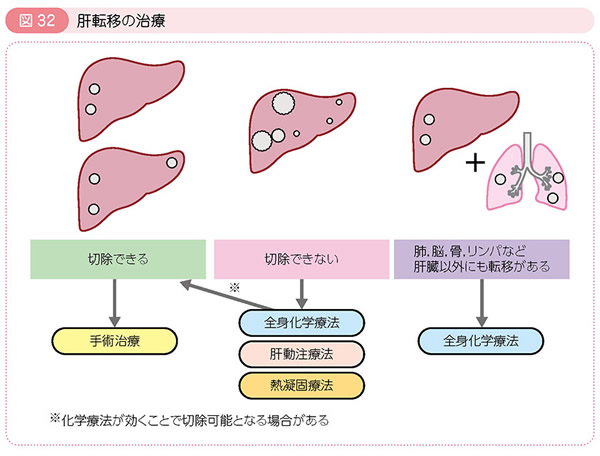 図32 肝転移の治療