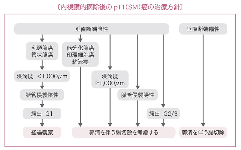 内視鏡的摘除後のpT1（SM）癌の治療方針