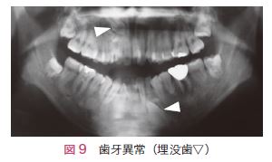 図9　歯牙異常（埋没歯▽）