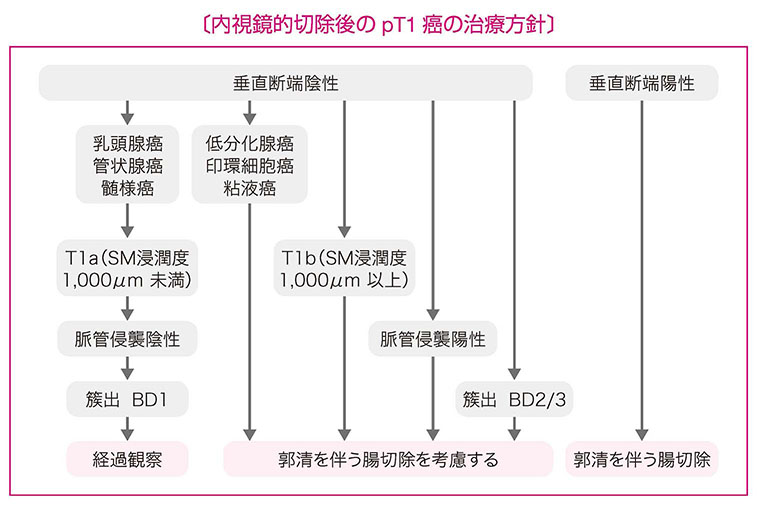 内視鏡的切除後のpT1癌の治療方針