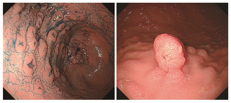 図9　胃腺腫（左：陥凹型，右：隆起型）