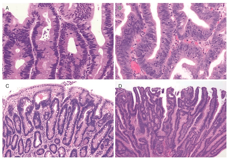 図11　FAPに合併する十二指腸腺腫の組織像