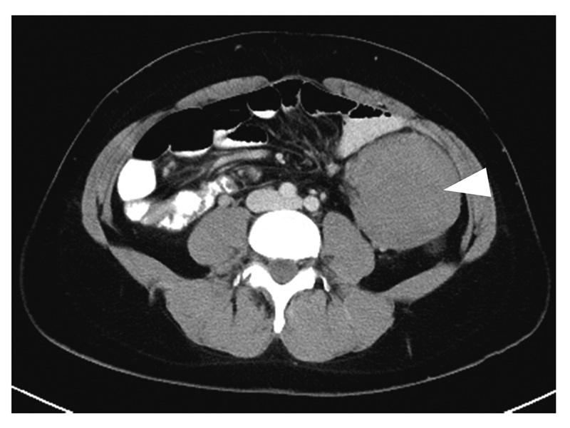 図14　腹腔内デスモイド腫瘍（▽）
