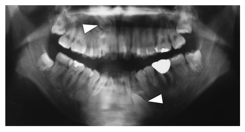 図16　歯牙異常（埋没歯▽ ）