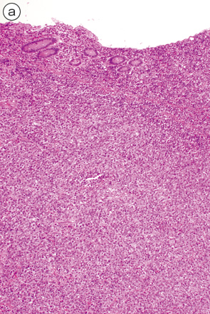 大腸びまん性大型B細胞性リンパ腫a