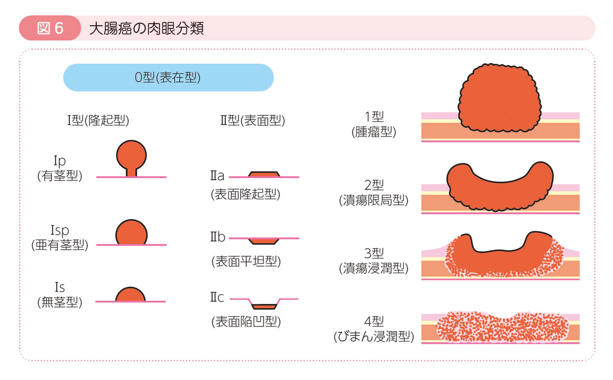 図6 大腸癌の肉眼分類