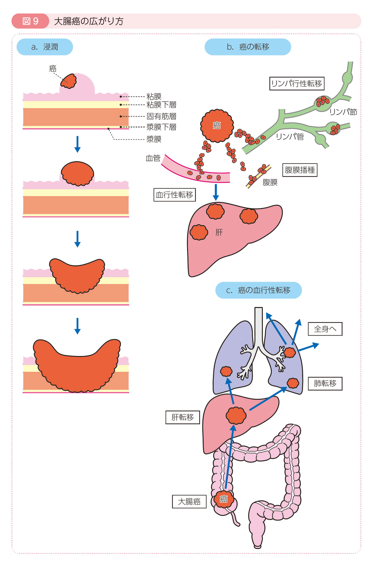 図9 大腸癌の広がり方