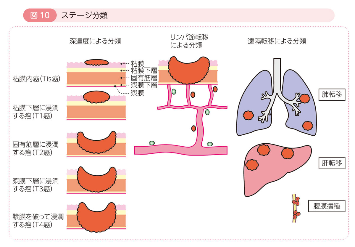 図10 ステージ分類