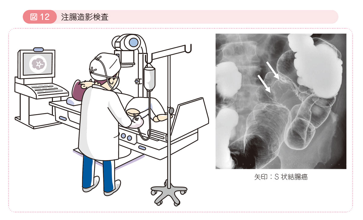 図12 注腸造影検査