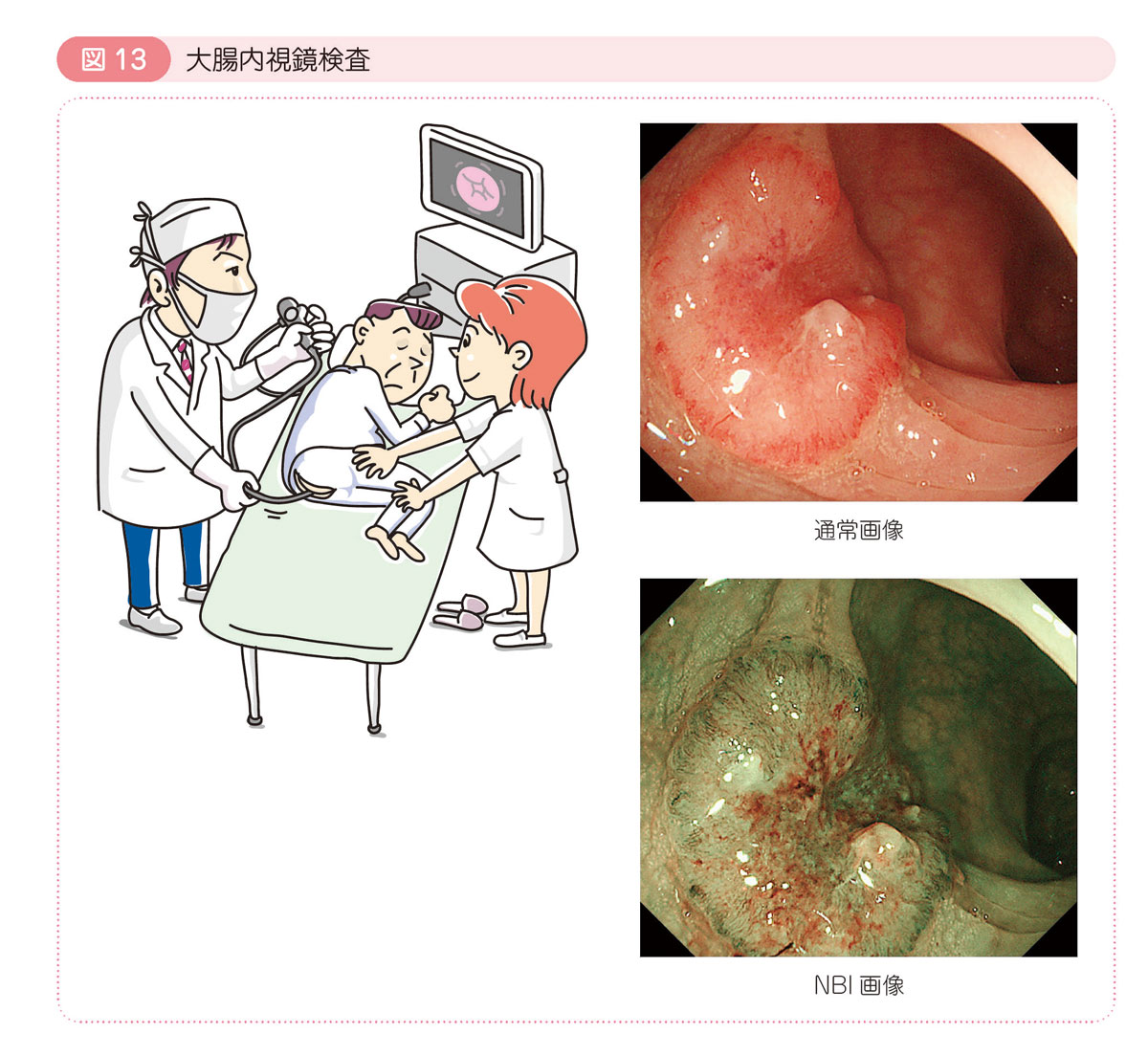 図13 大腸内視鏡検査