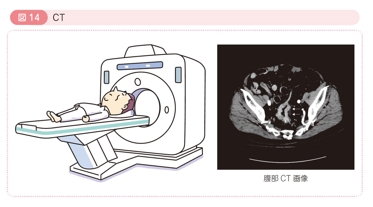 図14 CT