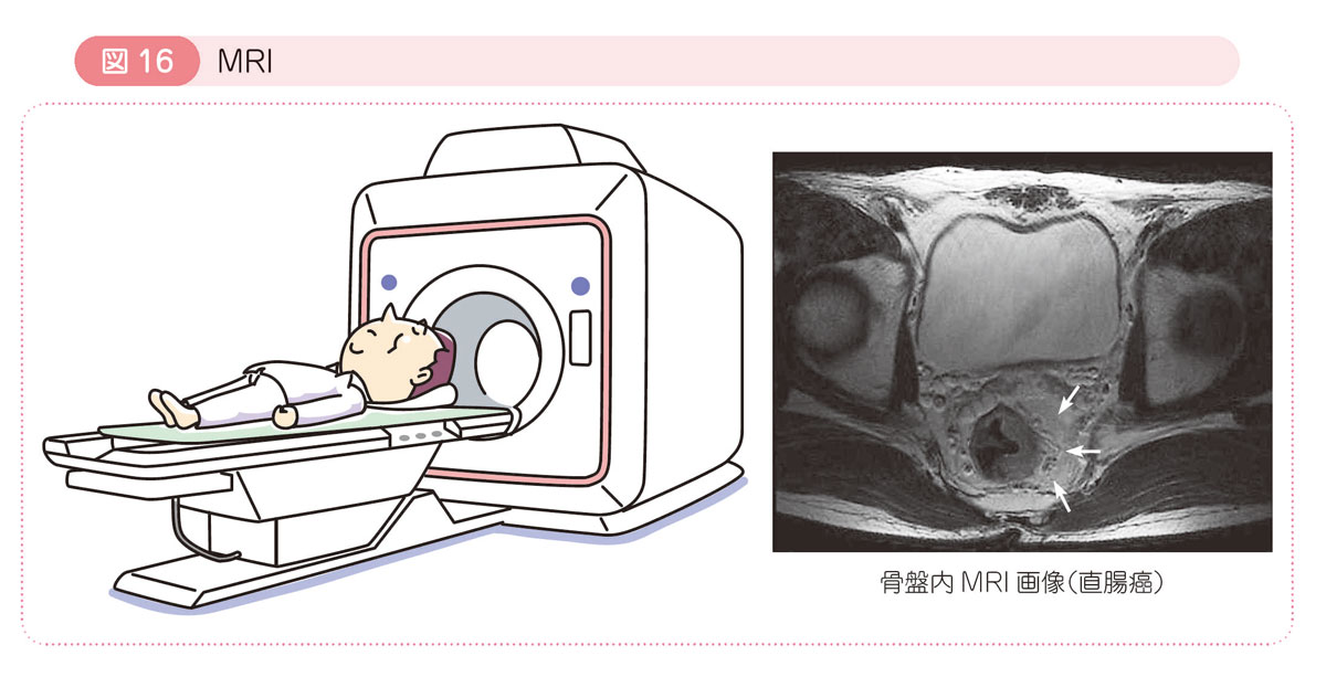 図16 MRI