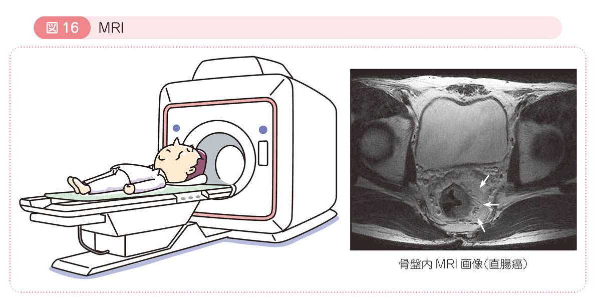 図16 MRI