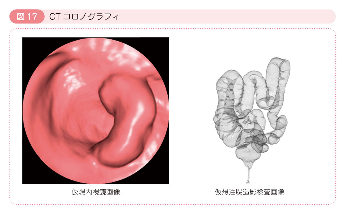 図17 CTコロノグラフィ