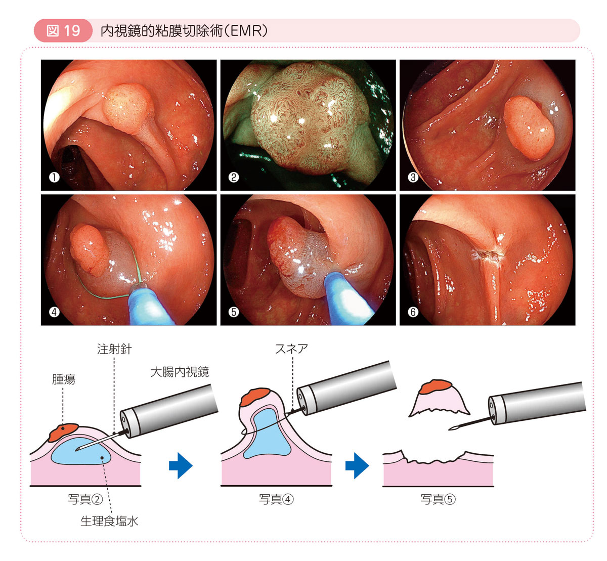 図19 内視鏡的粘膜切除術（EMR）