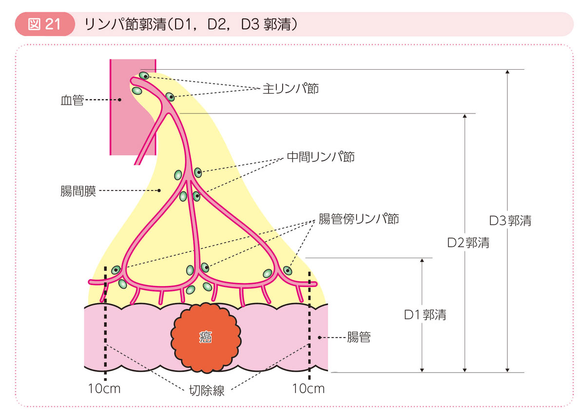 図21 リンパ節郭清（D1，D2，D3郭清）