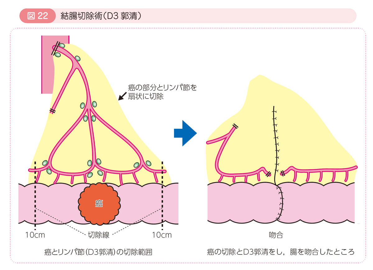 図22 結腸切除術（D3郭清）