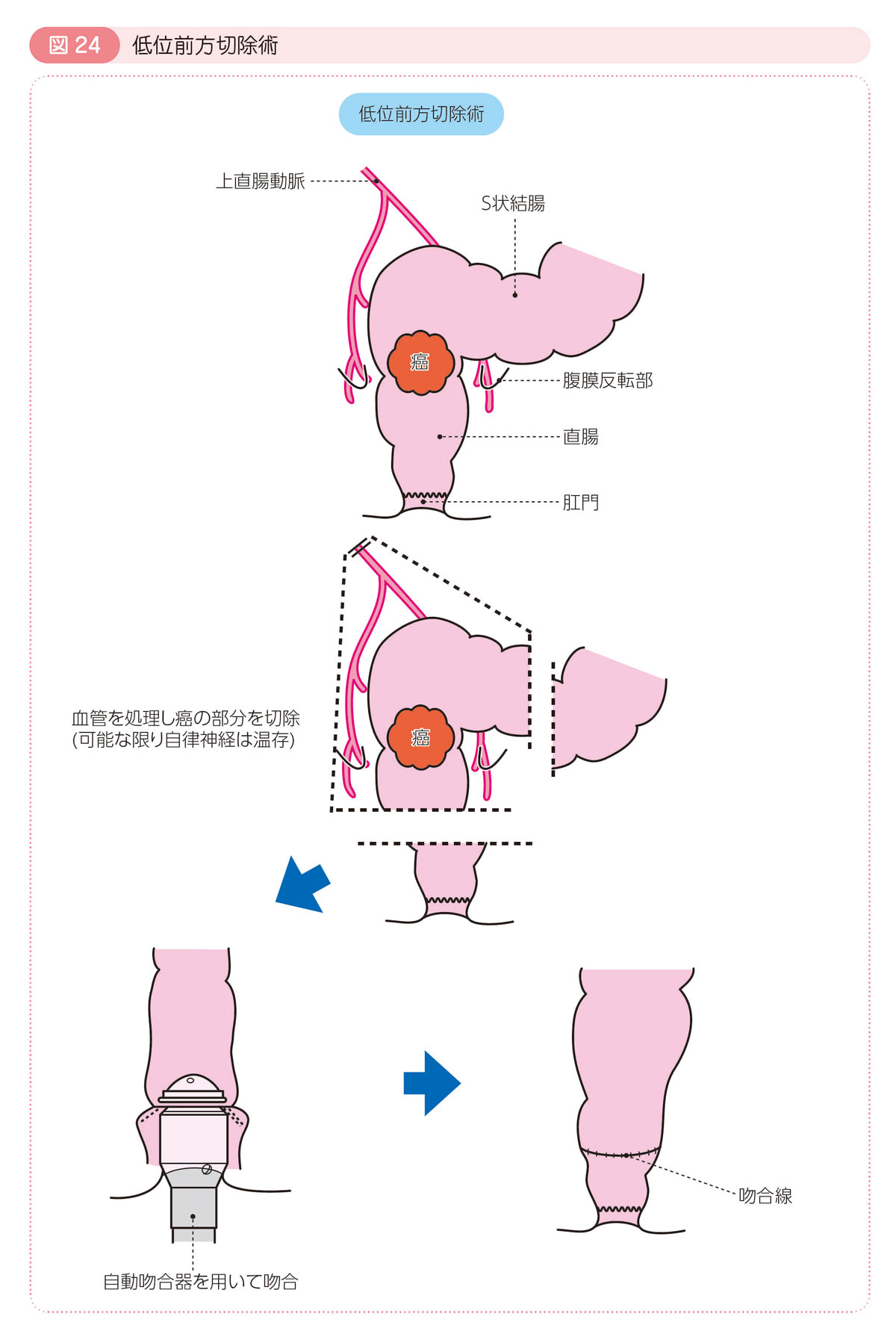 図24 低位前方切除術