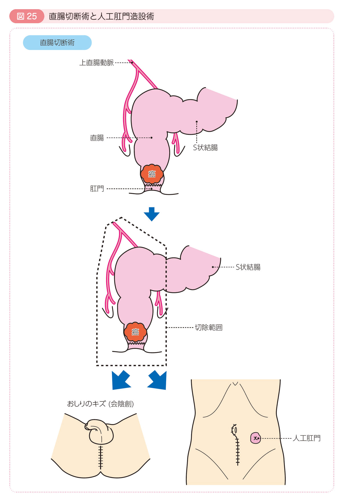 図25 直腸切断術と人工肛門造設術