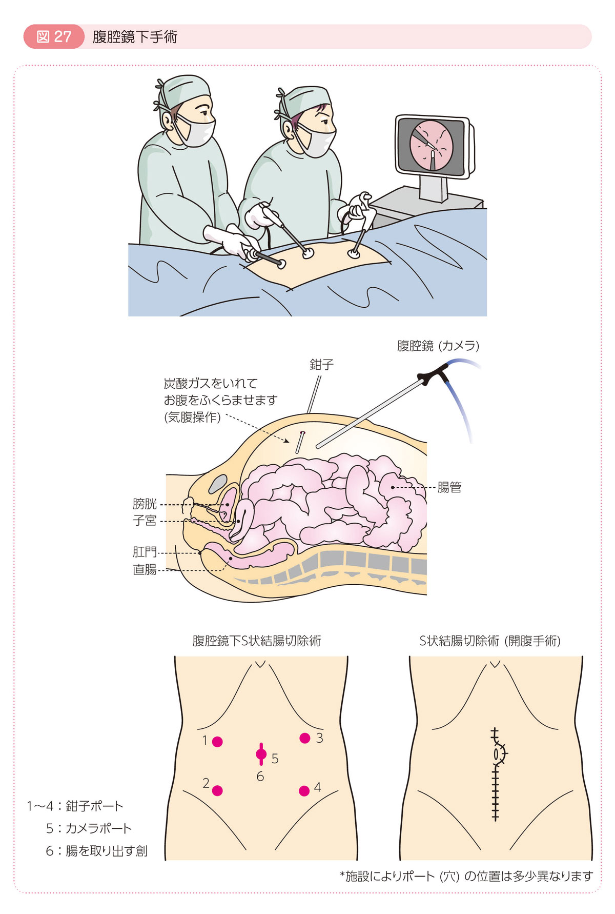 図27 腹腔鏡下手術