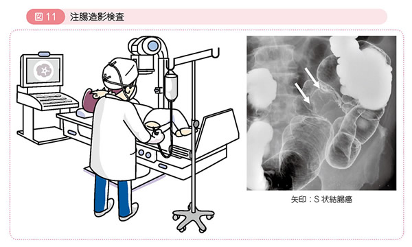 図11 注腸造影検査