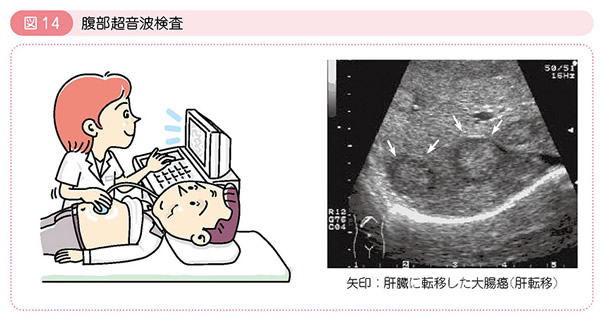 図14 腹部超音波検査