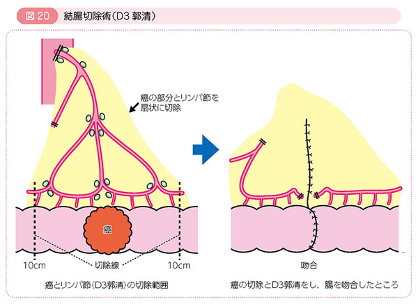 図20 結腸切除術（D3郭清）