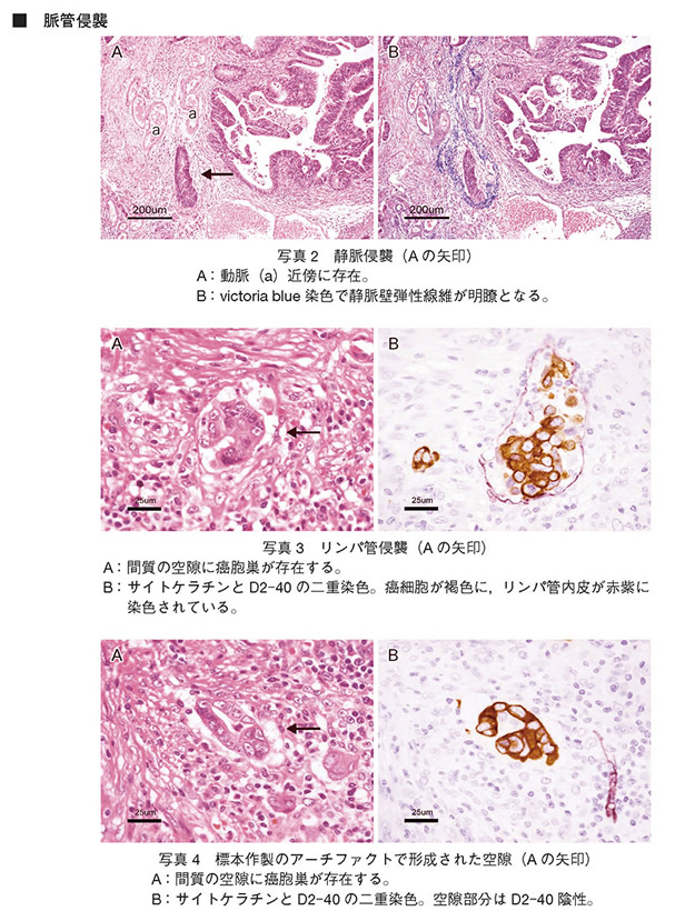 写真2　静脈侵襲　写真3　リンパ管侵襲　写真4　標本作製のアーチファクトで形成された空隙