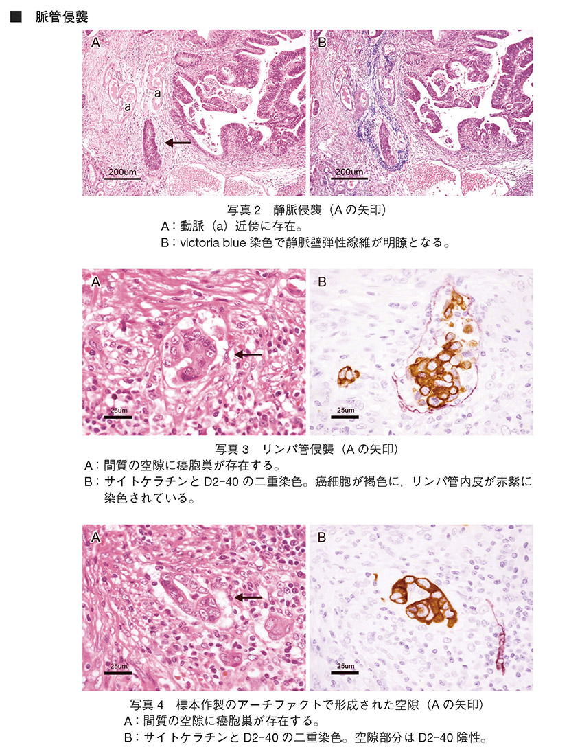 写真2　静脈侵襲　写真3　リンパ管侵襲　写真4　標本作製のアーチファクトで形成された空隙