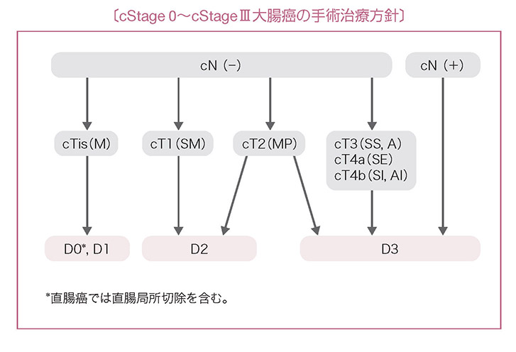 cStage 0～cStageⅢ大腸癌の手術治療方針