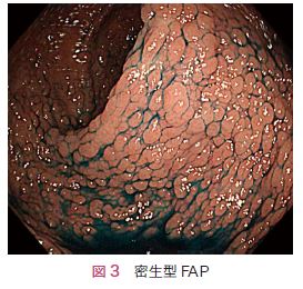 図3　密生型FAP