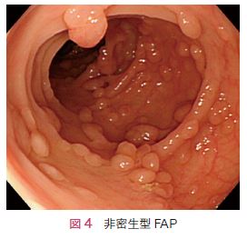 図4　非密生型FAP