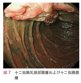 図7　十二指腸乳頭部腺腫および十二指腸腺腫