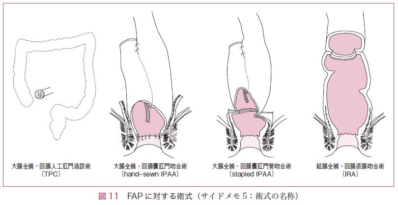 図11　FAPに対する術式（サイドメモ5：術式の名称）