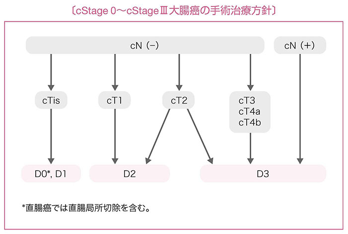 cStage 0～cStageⅢ大腸癌の手術治療方針