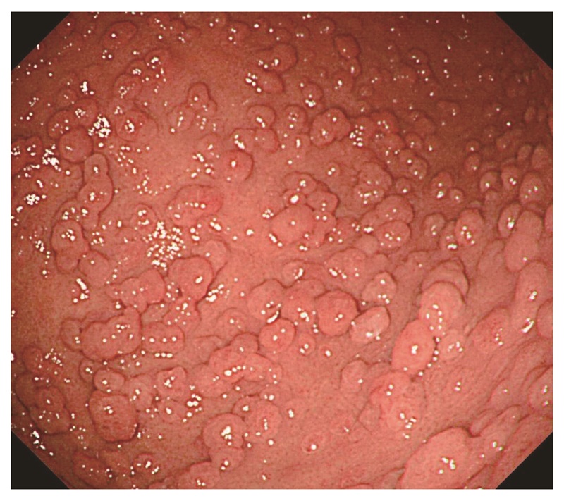 図8　胃底腺ポリポーシス