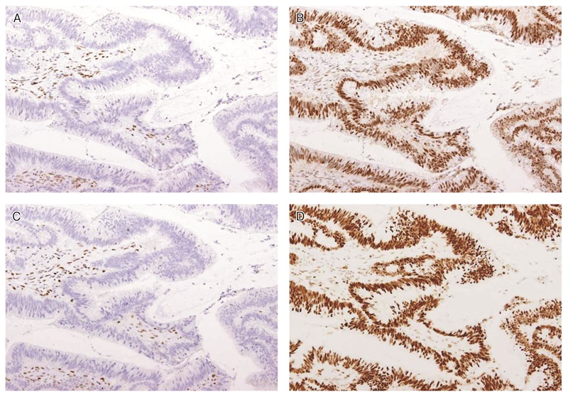 図26　MLH1遺伝子変異リンチ症候群に伴う大腸癌におけるミスマッチ修復タンパク染色例