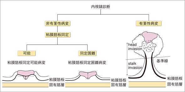 大腸pSM癌の浸潤距離の測り方の図解