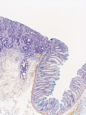 無茎性塊状粘膜下浸潤癌（いわゆるIs ＋ IIc）癌